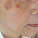 美肌プログラムでのシミ改善ビフォーのイメージ